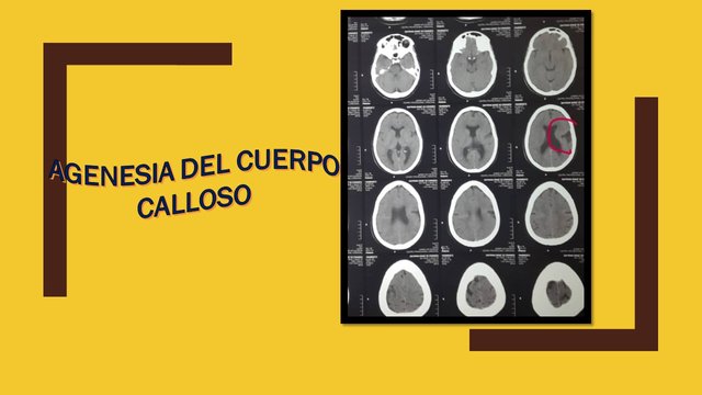 agenesia del corpo calloso imaging services